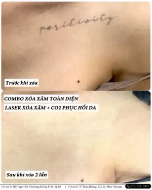 Tattoo Removal