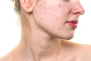 Xoá Tan Mụn Toàn Diện
