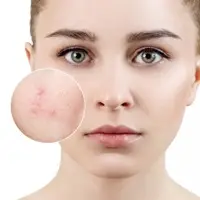 Trị Mụn Và Trẻ Hoá
