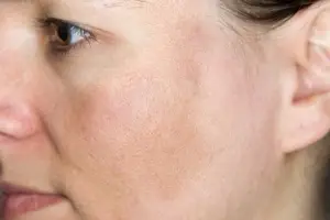 Điều Trị Nám Mảng Thể Nhẹ ( 60day )