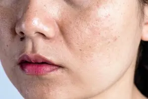 Điều Trị Nám Nội Tiết Chuyên Sâu ( 3-6 tháng )