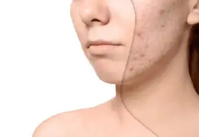 Quy Trình Điều Trị Sẹo Rổ Thể Nhẹ ( từ 2 tháng )