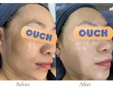 Brightening & Melasma Mesotherapy