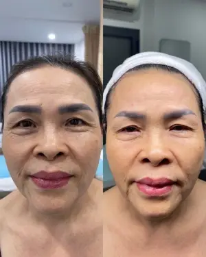 Full Face Anti-Wrinkle & Lifting