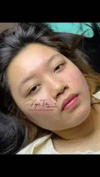 Điều Trị Mụn chuẩn y khoa