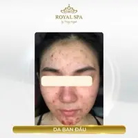 Mesotherapy Glow Treatment