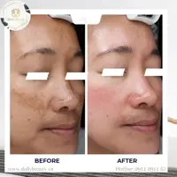 HYDRO DIAMOND - CẢI THIỆN SẮC TỐ, NÁM, TÀN NHANG