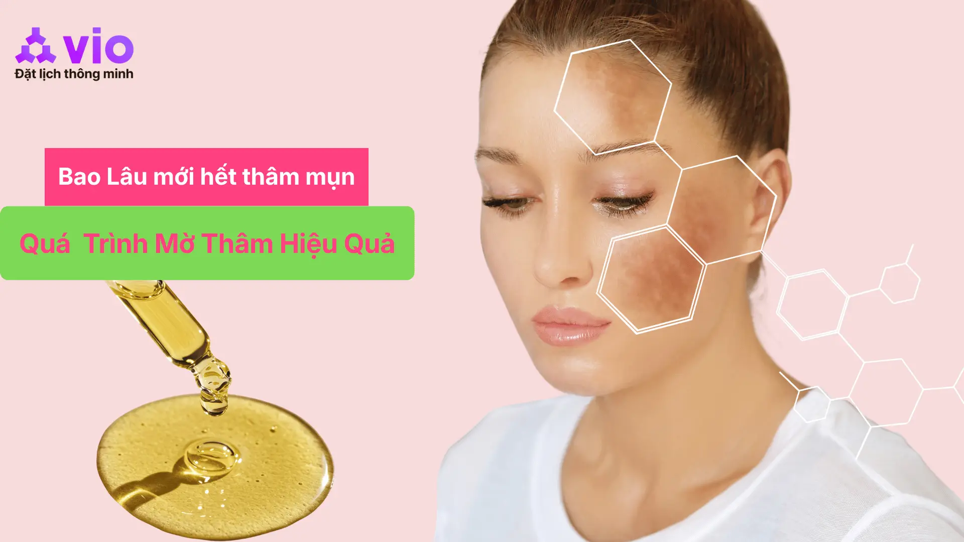 How Long Does Acne Hyperpigmentation Last? The Truth About Fading Dark Marks That Many People Don't Know